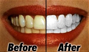 Tips Petua Putihkan Gigi Kuning Guna Bahan Semulajadi