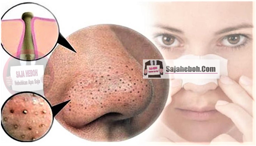 SAJAHEBOH.COM - Cara Mudah Menghilangkan Bintik Hitam, Mengecilkan Pori Pada Wajah Dan Melicinkan Kulit Muka 