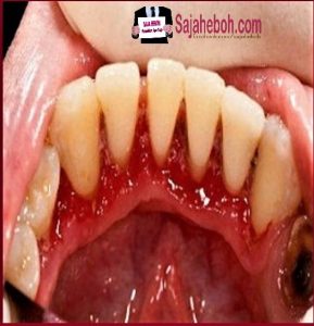 SAJAHEBOH.COM - Petua Tips Untuk Hilangkan Karang Gigi Tanpa Perlu Jumpa Doktor