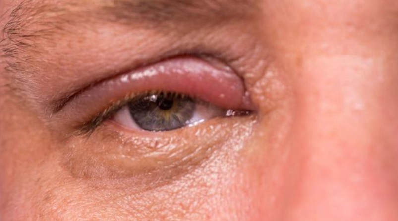SAJAHEBOH.COM - Keadaan Mata Boleh Tunjukkan Masalah Kesihatan Seseorang. Ini 10 Keadaan Mata Yang Bermasalah Kesihatan