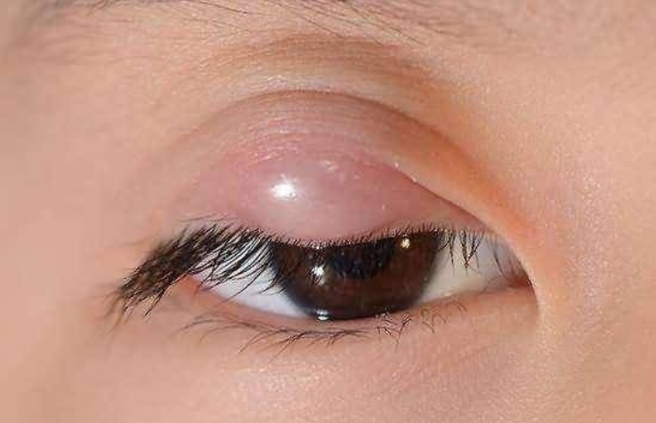 SAJAHEBOH.COM - Keadaan Mata Boleh Tunjukkan Masalah Kesihatan Seseorang. Ini 10 Keadaan Mata Yang Bermasalah Kesihatan