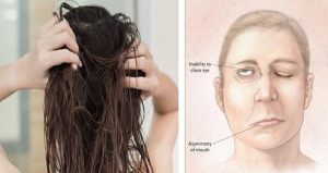 SAJAHEBOH.COM - Mengejutkan! Akibat Kerap Tidur Dengan Rambut Yang Masih Basah, Wanita Ini Mengalami Lumpuh Sebelah Muka
