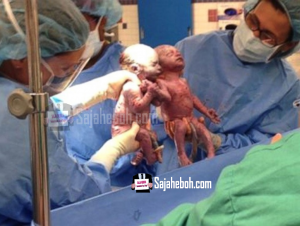 SAJAHEBOH.COM - Kelahiran Menakjubkan Bayi Kembar Berpegangan Tangan Ketika Dilahirkan, Kebarangkalian Berlaku 1 Dalam 10,000 Kelahiran . . . . . . . . . . . . . . . . . . Sajaheboh.com