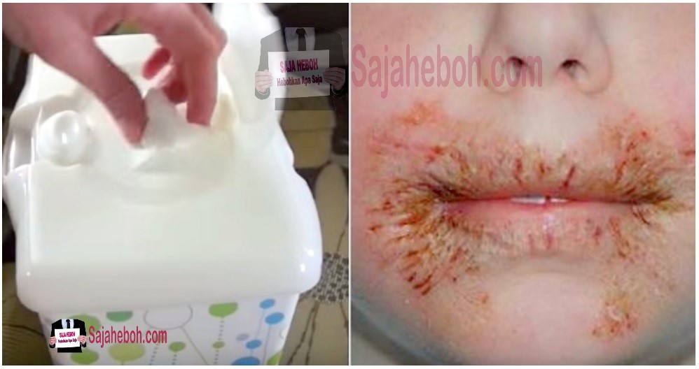 SAJAHEBOH.COM - Amaran Doktor: Jangan Sesekali Bersihkan Anak Anda Dengan Tisu Basah (Baby Wipes), Sangat BAHAYA Untuk Si Kecil