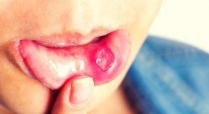 SAJAHEBOH.COM - Petua Cara Merawat Ulser Mulut Yang Berkesan